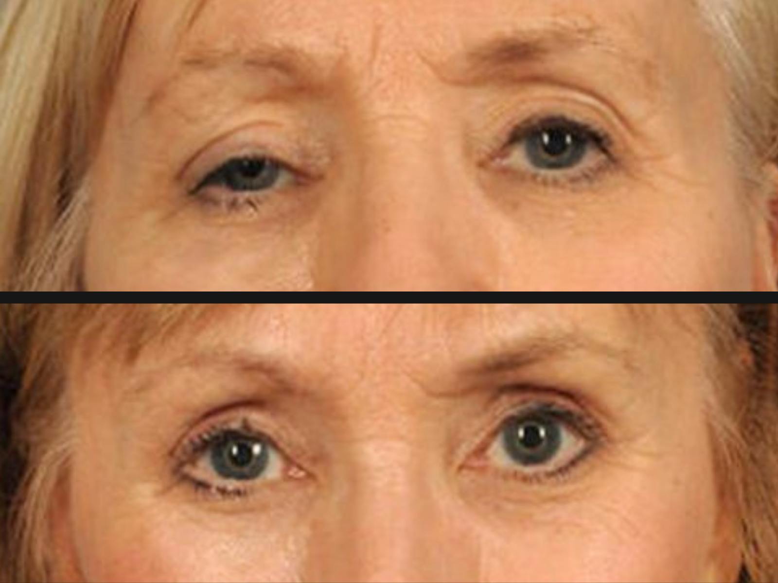 Droopy Eyelids – Ptosis Before & After Gallery - Patient 245463 - Image 2