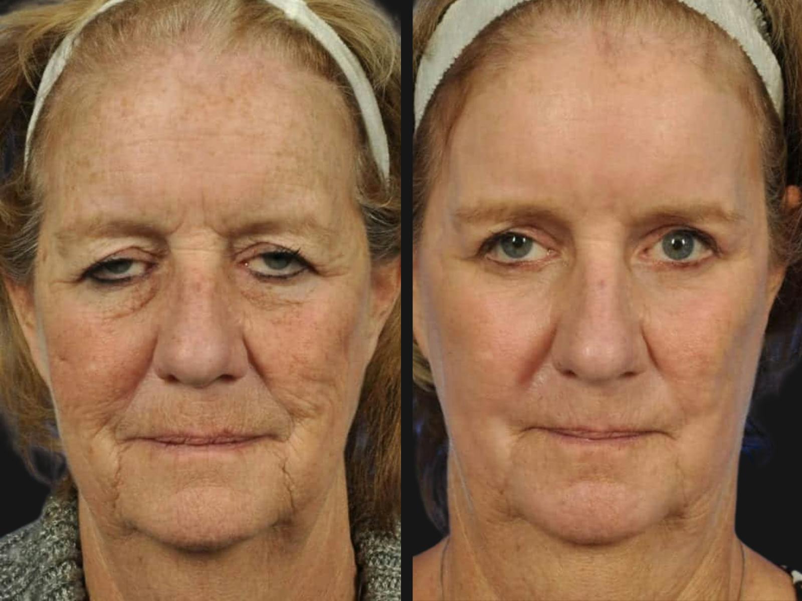 Droopy Eyelids – Ptosis Before & After Gallery - Patient 170980 - Image 1