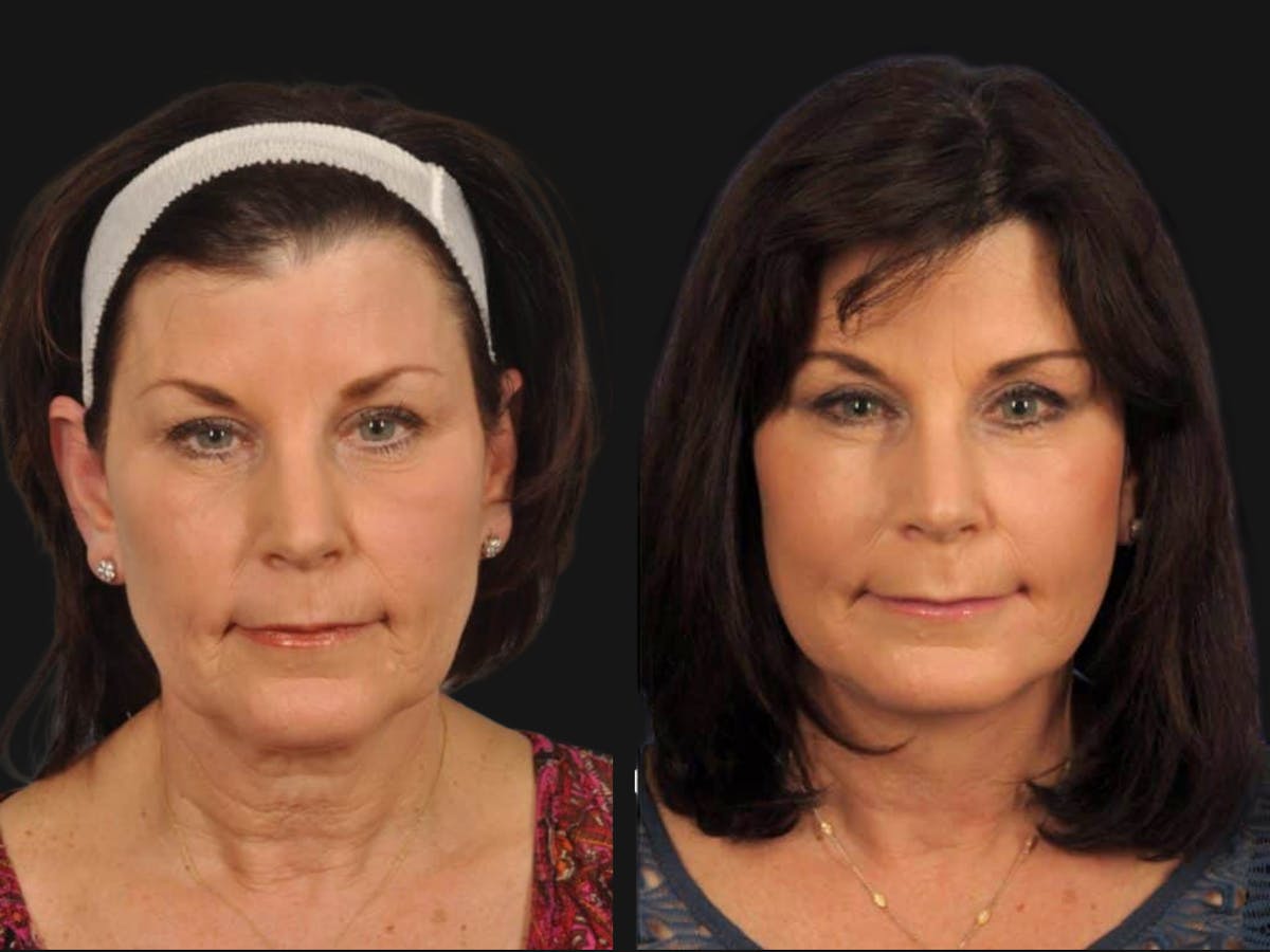 Droopy Eyelids – Ptosis Before & After Gallery - Patient 327512 - Image 1