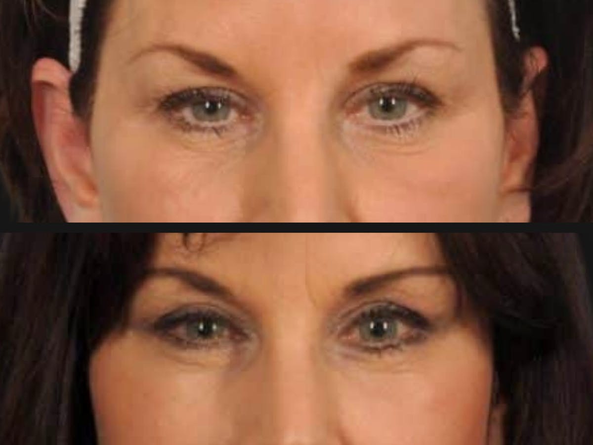 Droopy Eyelids – Ptosis Before & After Gallery - Patient 327512 - Image 2