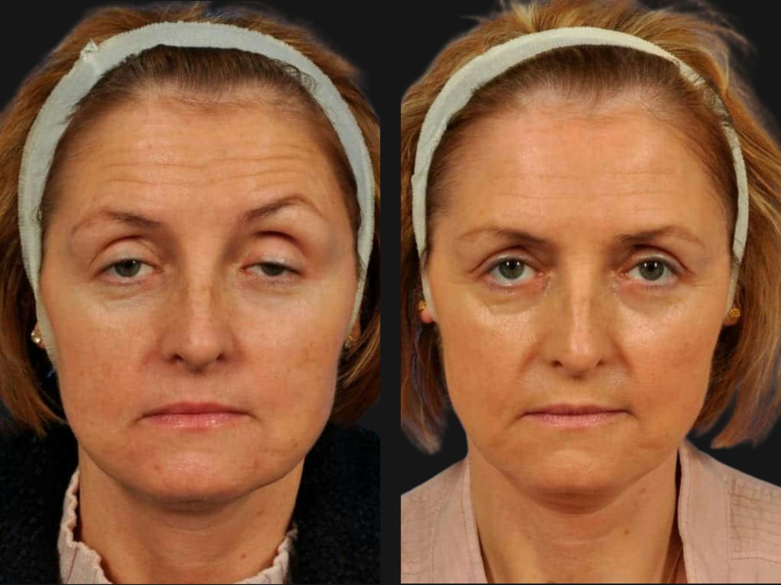 Droopy Eyelids – Ptosis Before & After Gallery - Patient 271731 - Image 1
