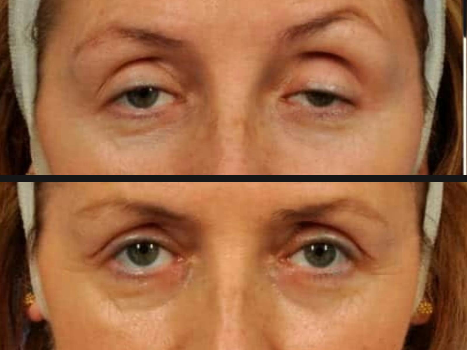 Droopy Eyelids – Ptosis Before & After Gallery - Patient 271731 - Image 2