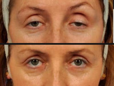 Droopy Eyelids – Ptosis Before & After Gallery - Patient 271731 - Image 2