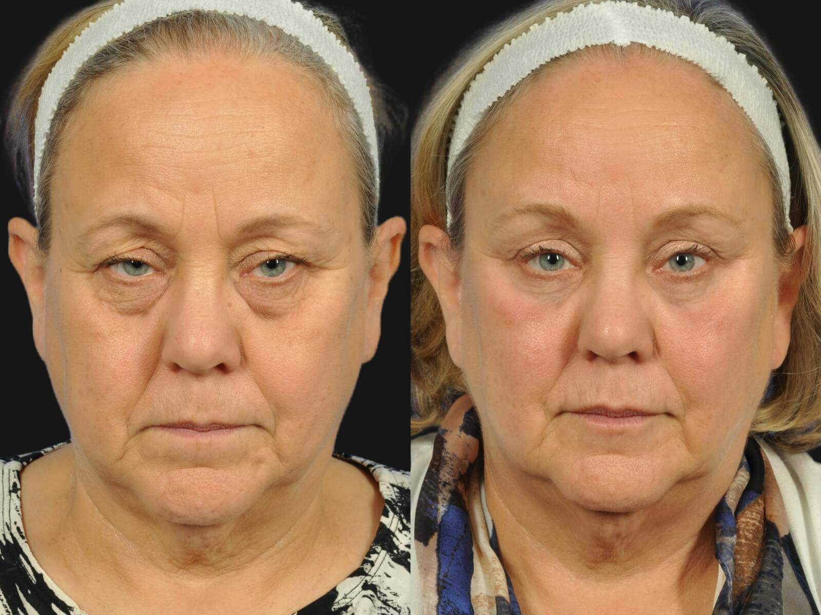 Blepharoplasty Before & After Gallery - Patient 317673 - Image 1