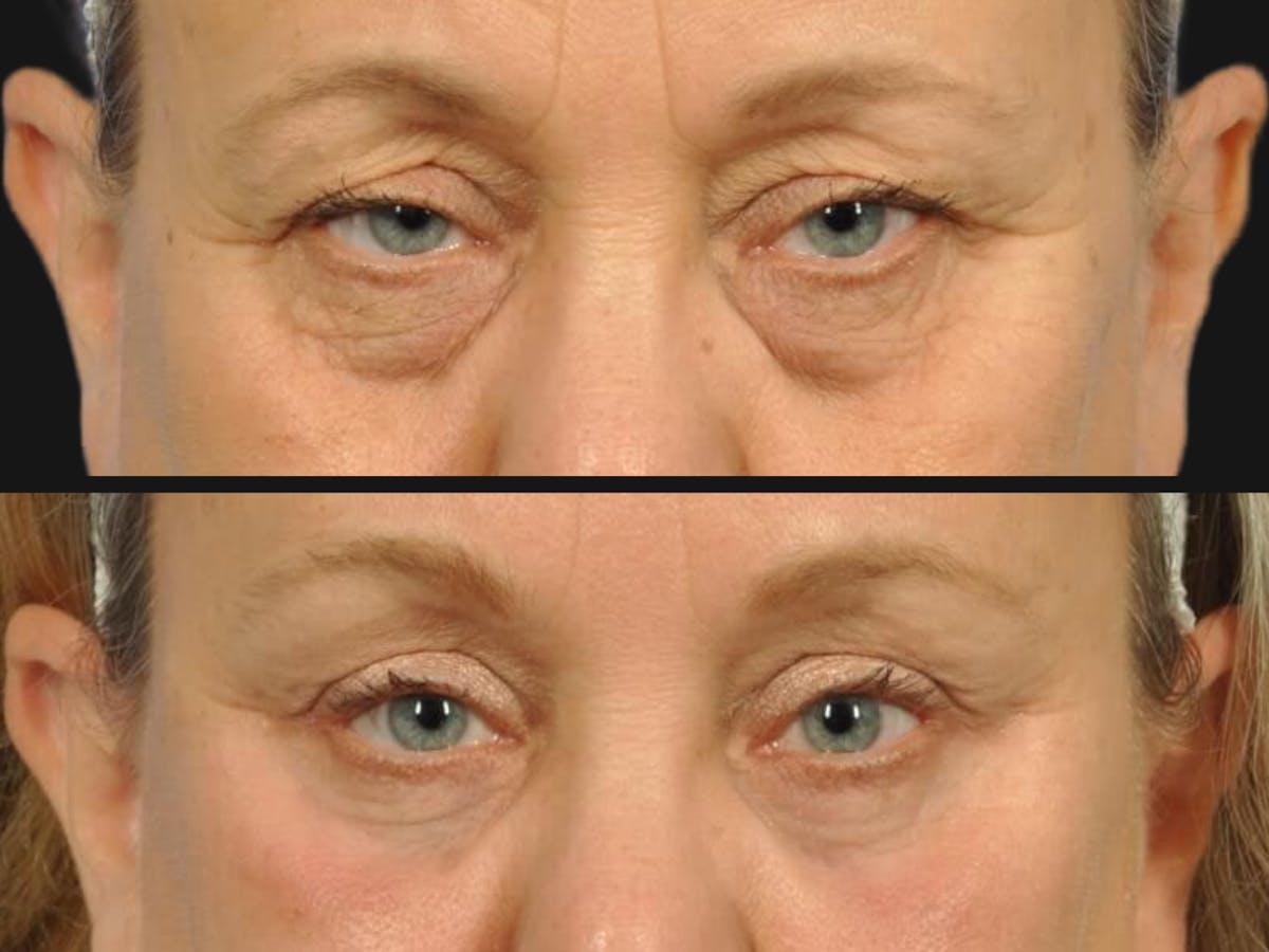 Blepharoplasty Before & After Gallery - Patient 317673 - Image 2