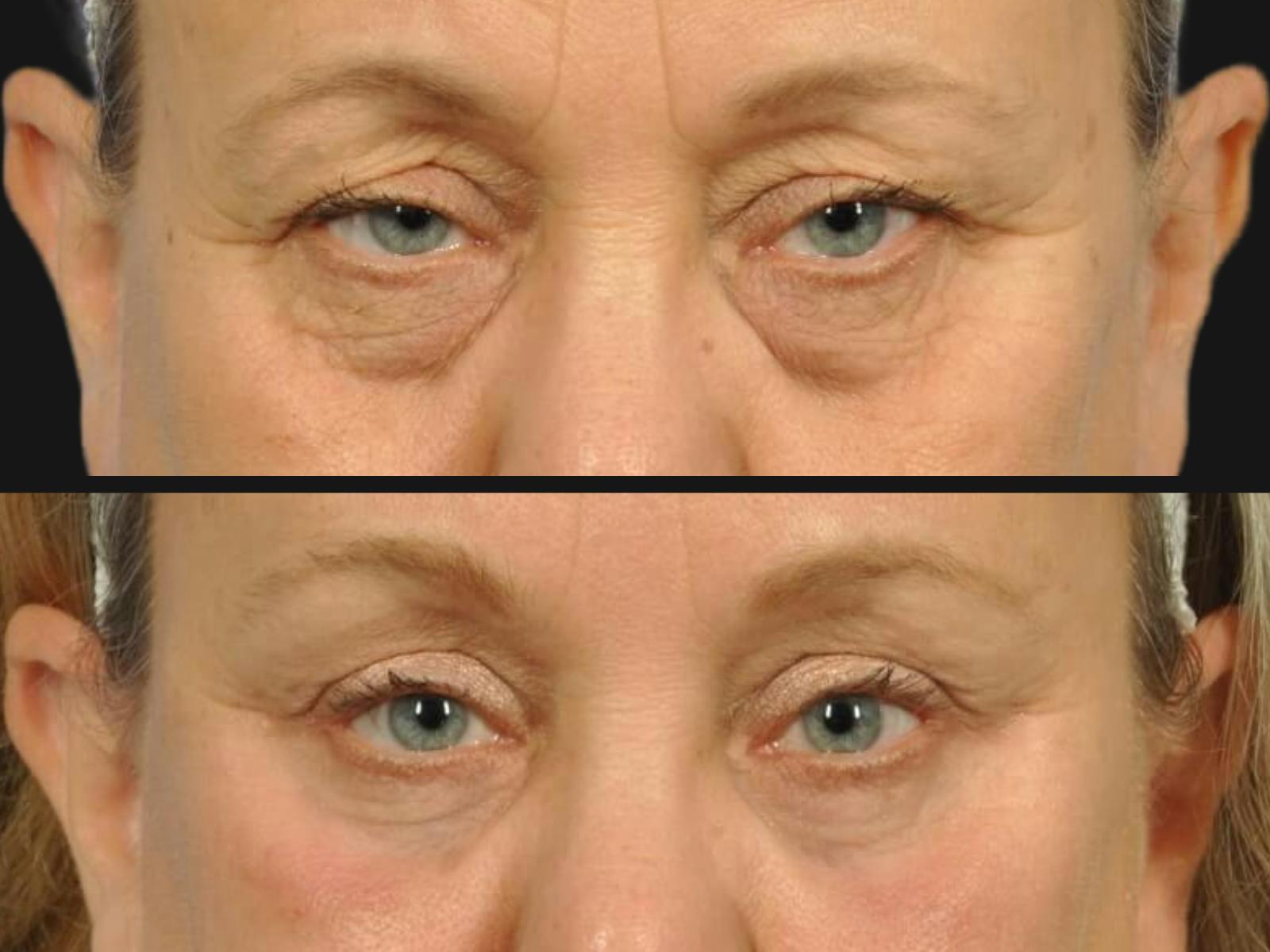 Blepharoplasty Before & After Gallery - Patient 317673 - Image 2