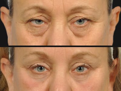 Droopy Eyelids – Ptosis Before & After Gallery - Patient 184417 - Image 2
