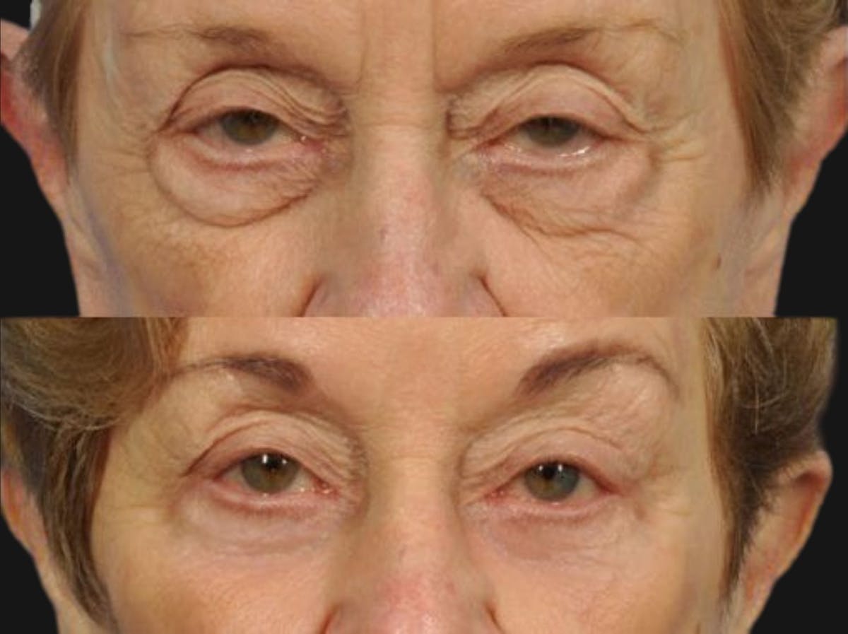 Droopy Eyelids – Ptosis Before & After Gallery - Patient 102848 - Image 1