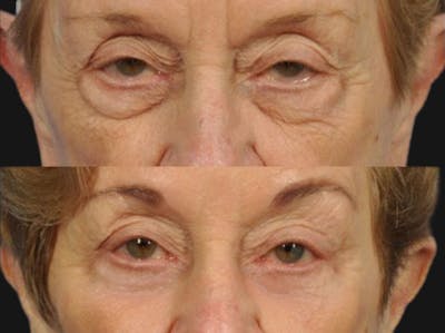 Droopy Eyelids – Ptosis Before & After Gallery - Patient 102848 - Image 1