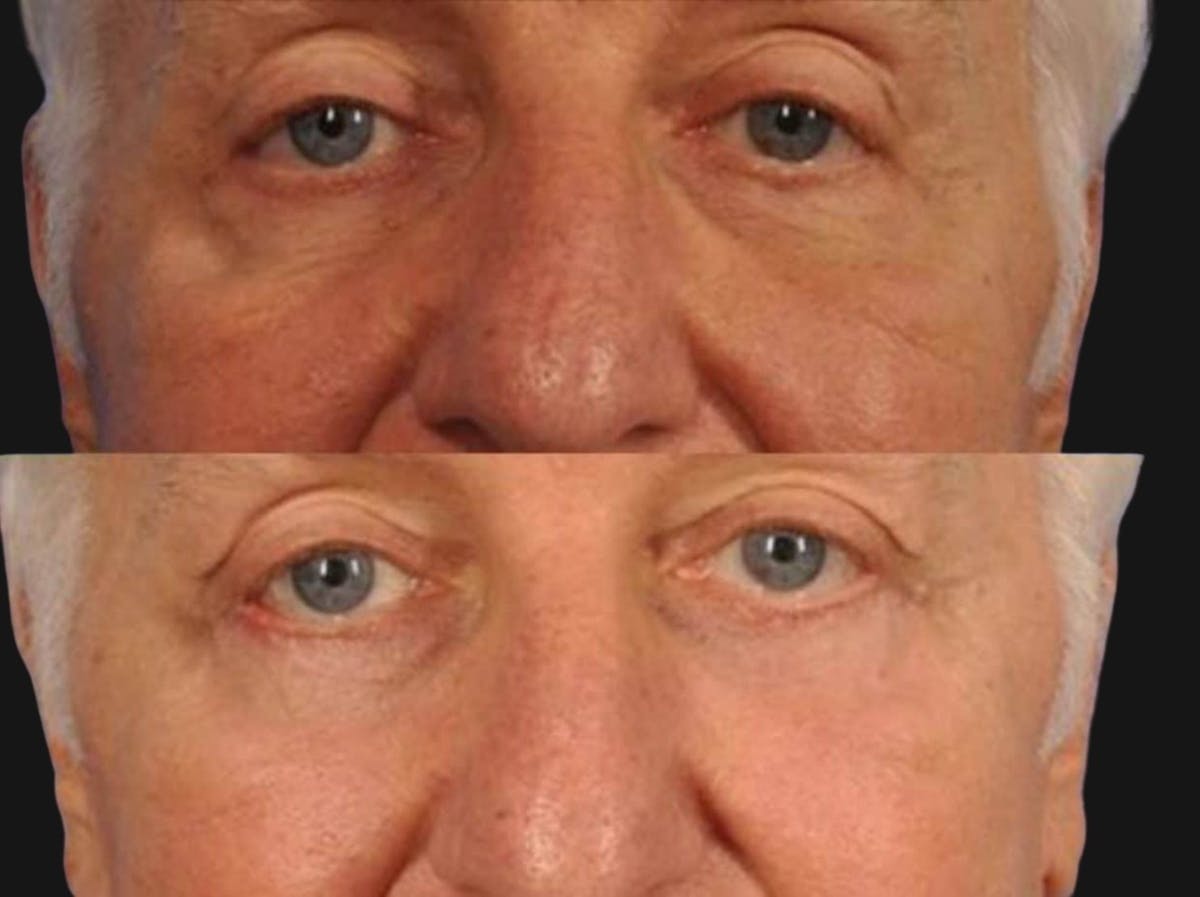 Festoon Surgery Before & After Gallery - Patient 216176 - Image 1