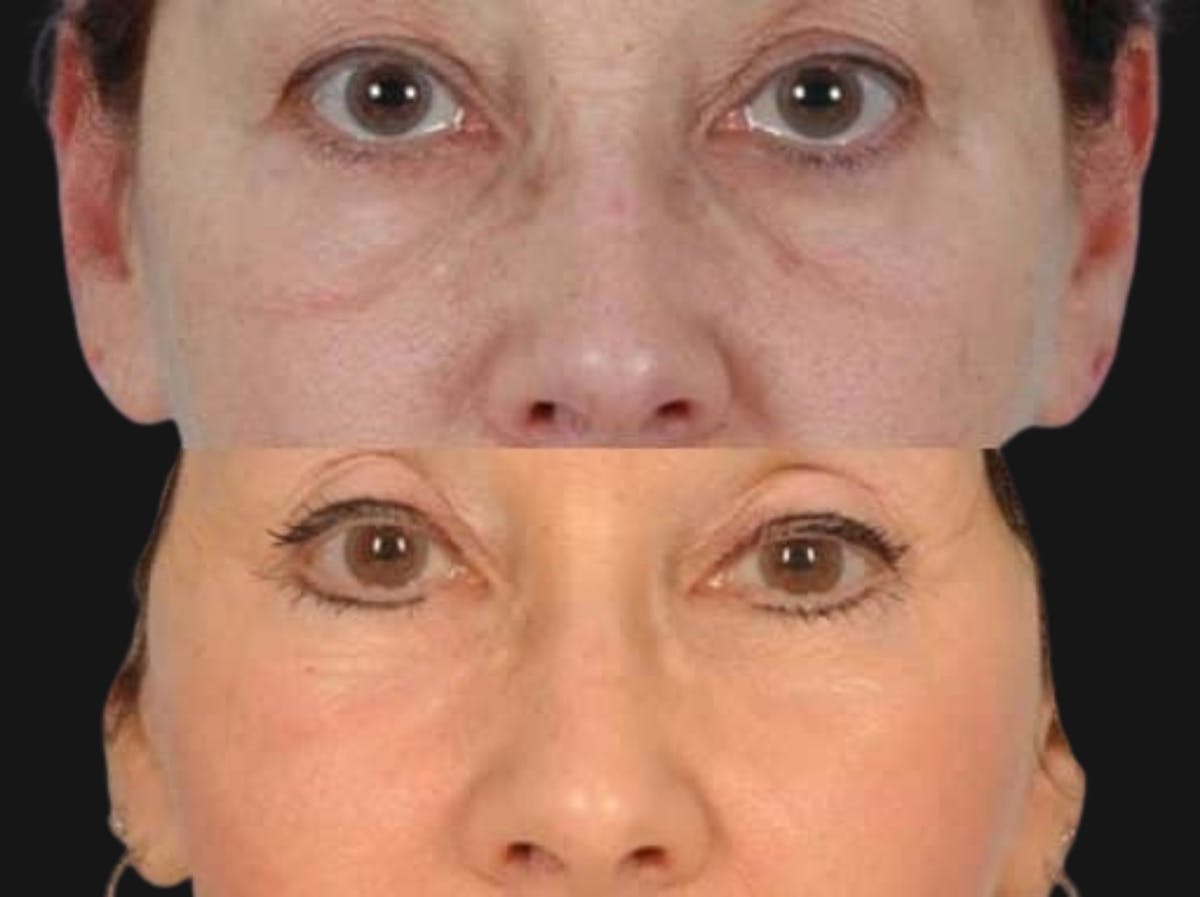 Festoon Surgery Before & After Gallery - Patient 911788 - Image 1