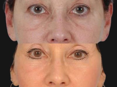 Festoon Surgery Before & After Gallery - Patient 911788 - Image 1