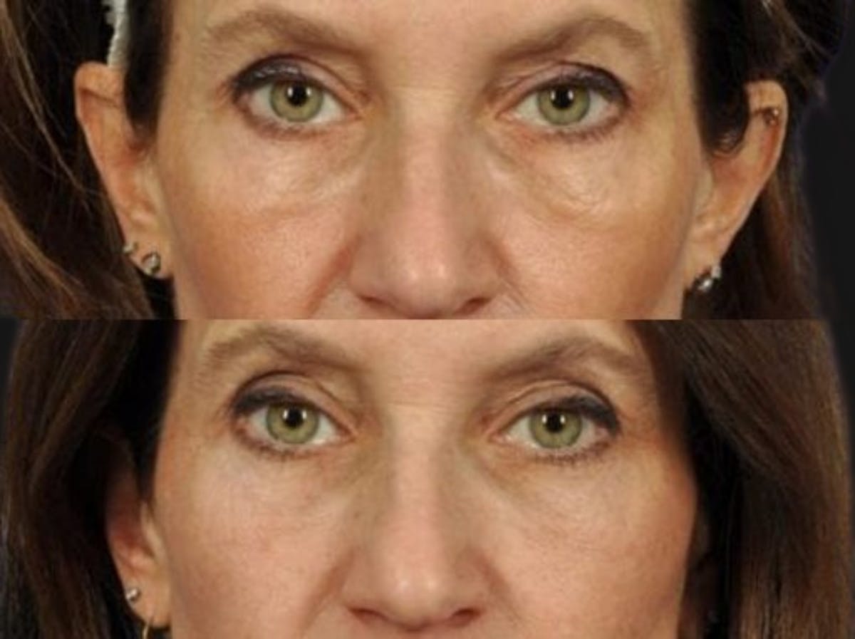 Festoon Surgery Before & After Gallery - Patient 426794 - Image 1