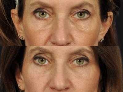 Festoon Surgery Before & After Gallery - Patient 426794 - Image 1