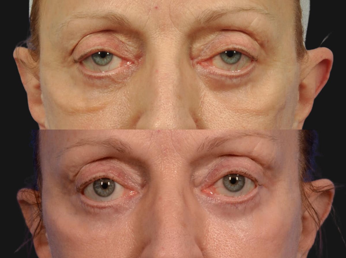 Festoon Surgery Before & After Gallery - Patient 364088 - Image 2