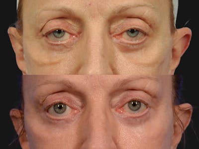 Festoon Surgery Before & After Gallery - Patient 364088 - Image 2