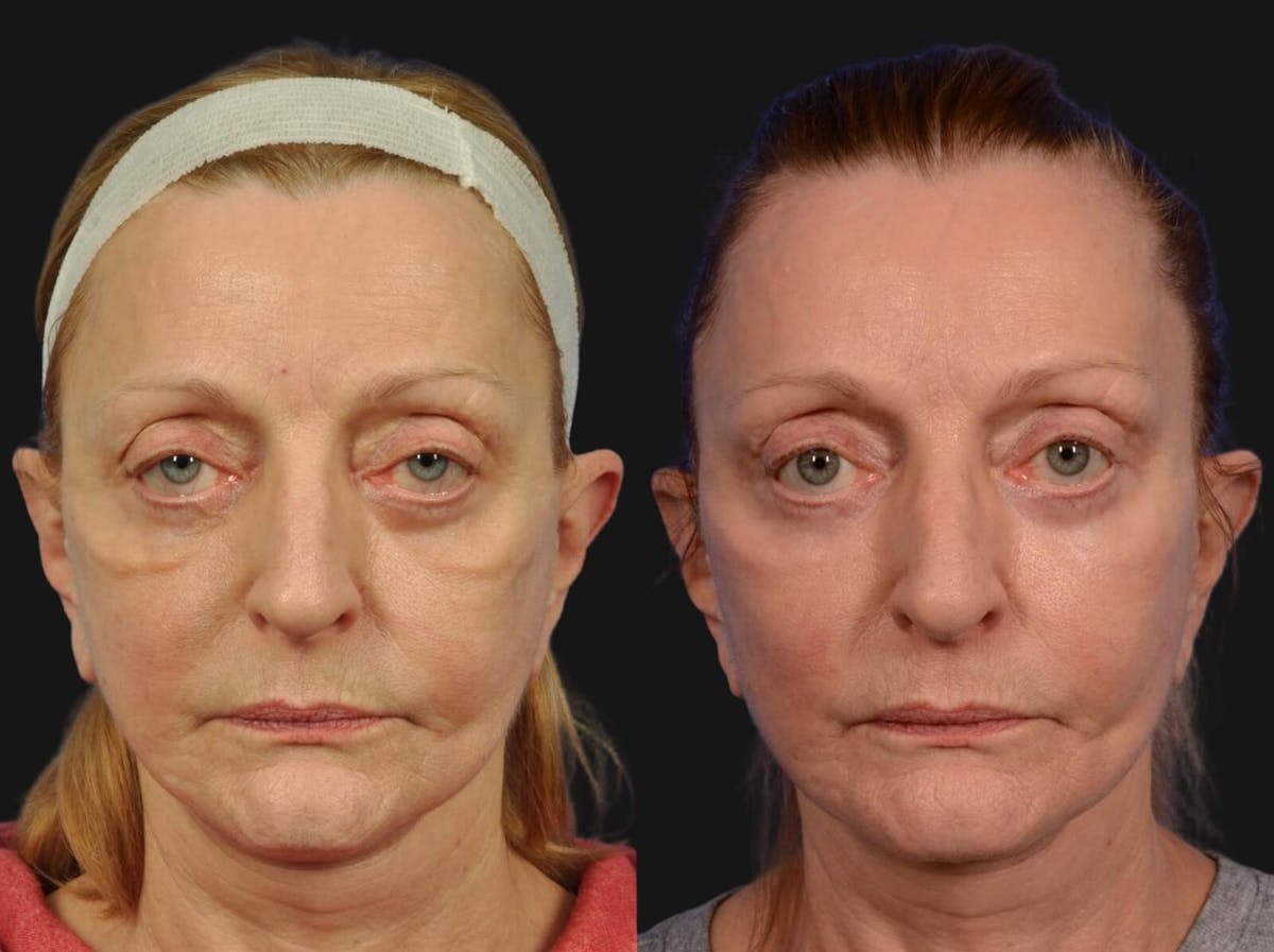 Festoon Surgery Before & After Gallery - Patient 364088 - Image 1