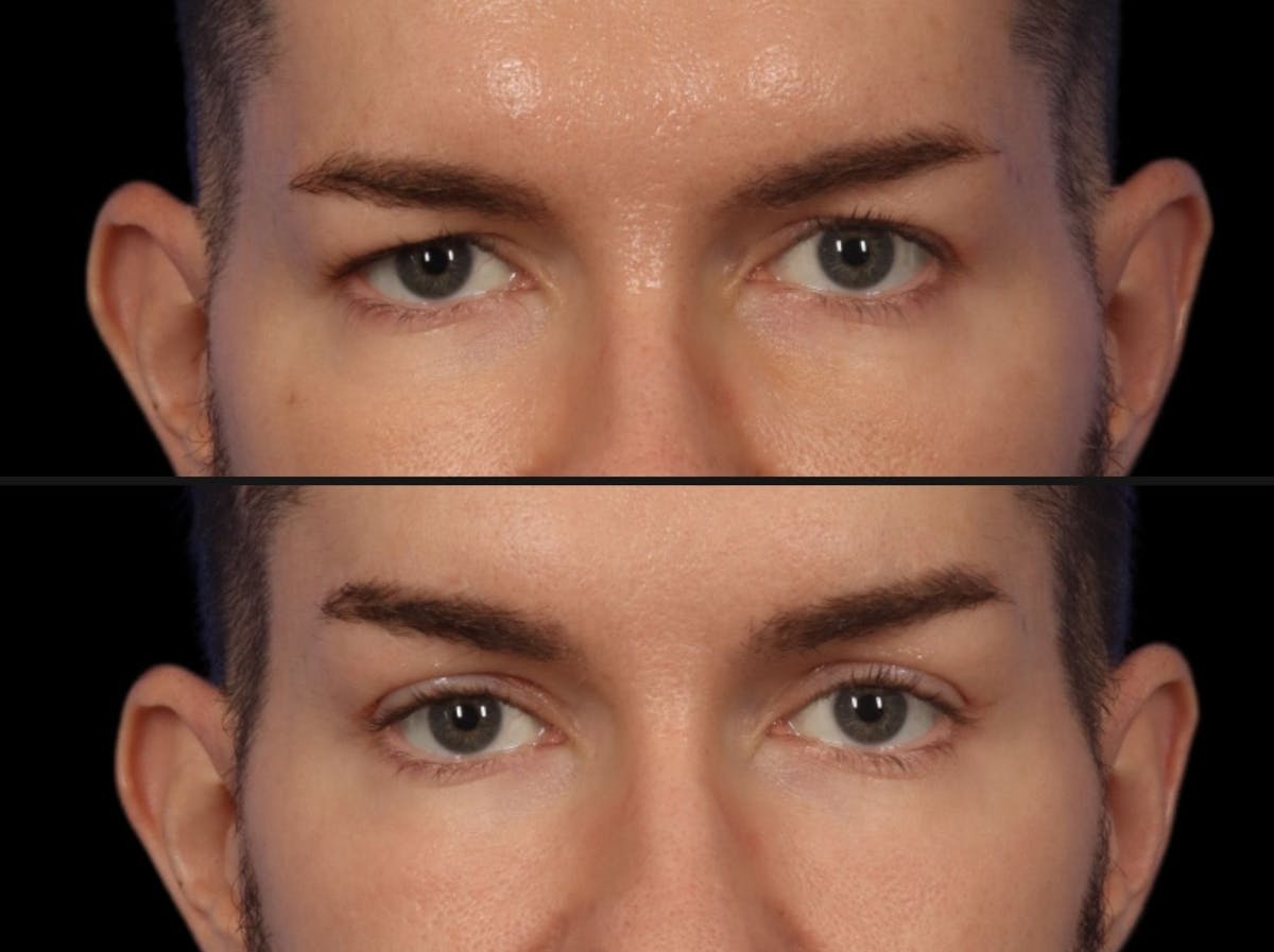 Brow Lift Before & After Gallery - Patient 289125 - Image 2