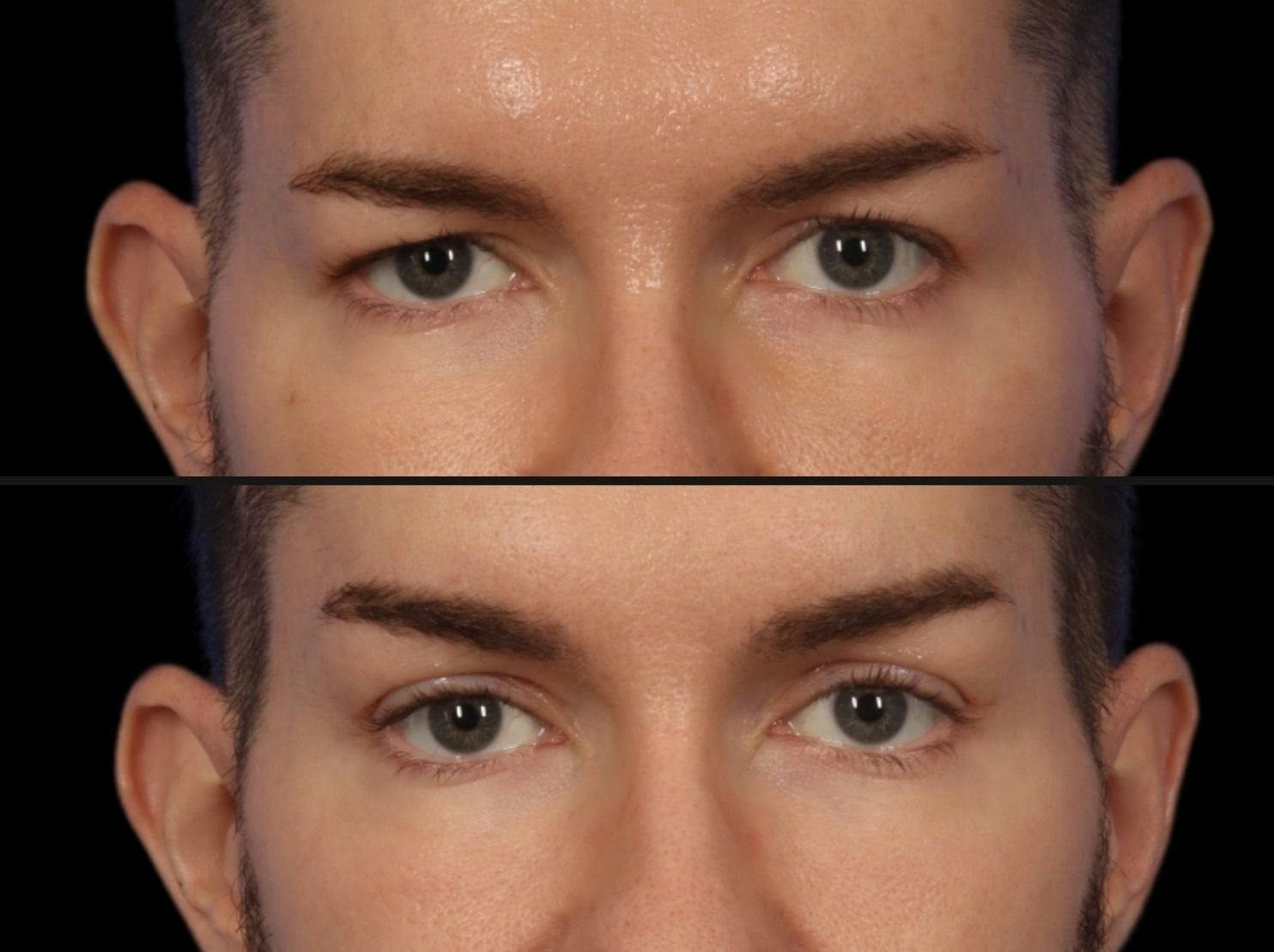 Brow Lift Before & After Gallery - Patient 289125 - Image 2