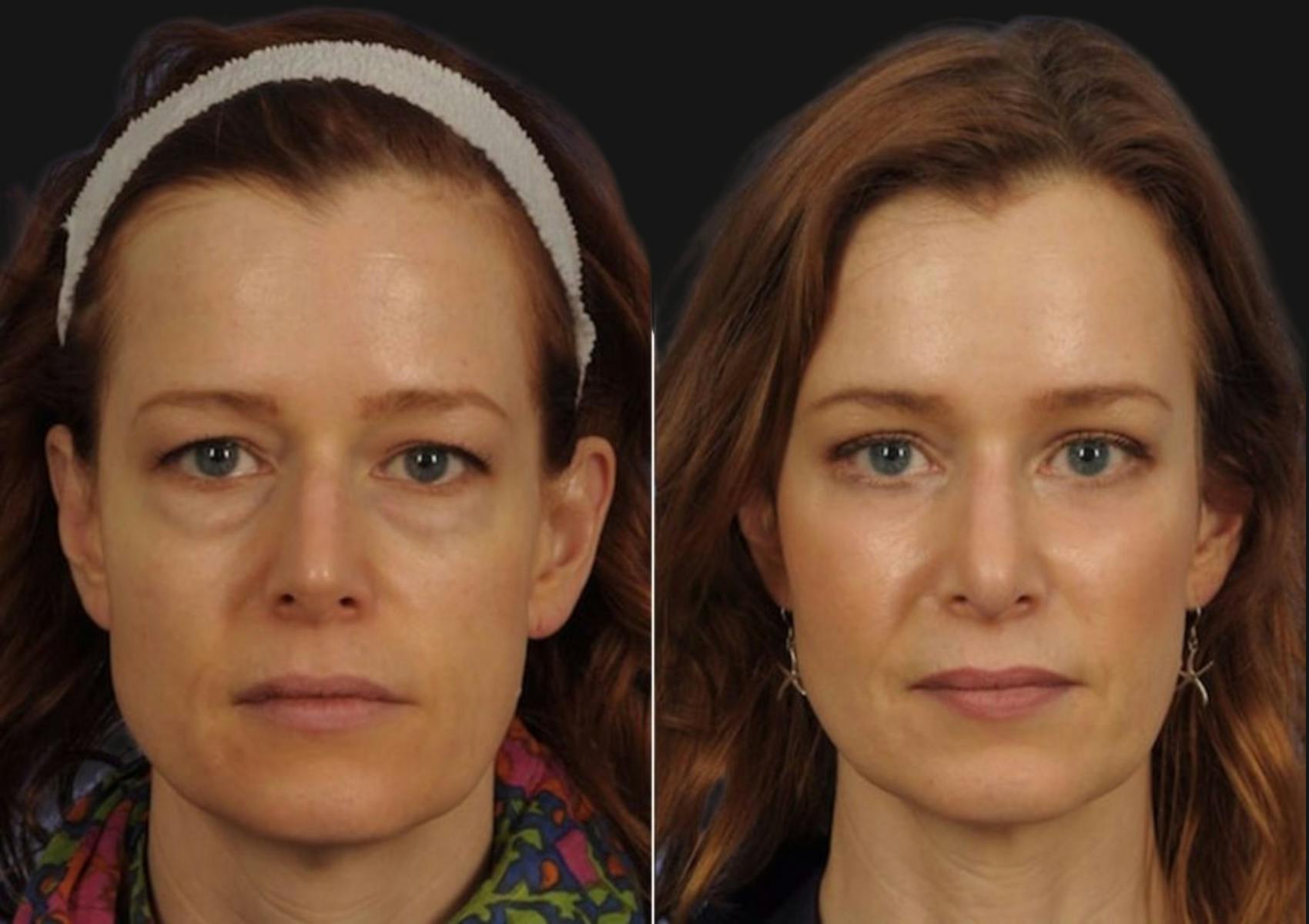 Brow Lift Before & After Gallery - Patient 233691 - Image 1