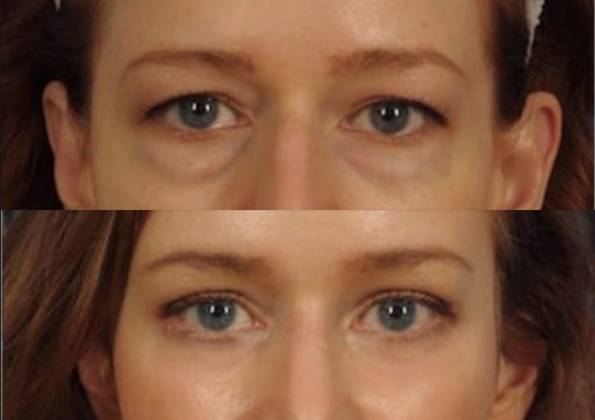Brow Lift Before & After Gallery - Patient 233691 - Image 2