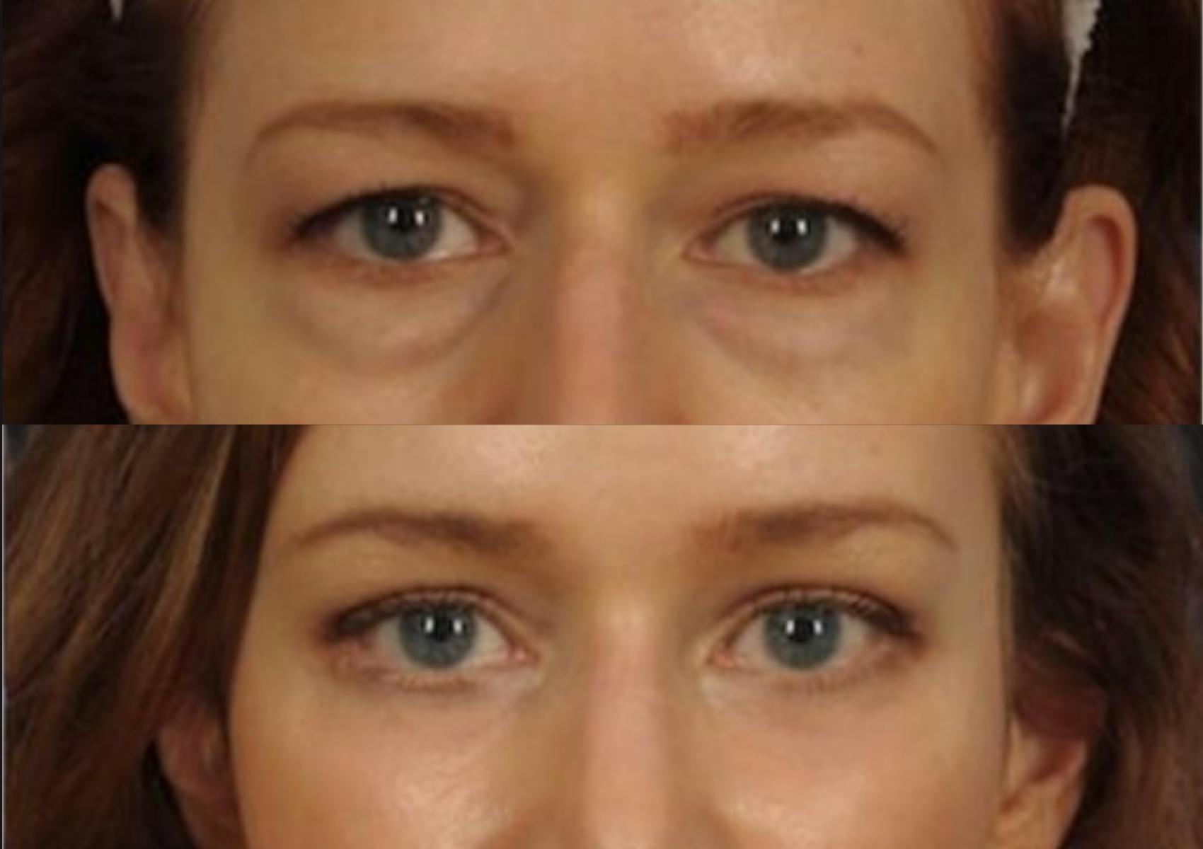Brow Lift Before & After Gallery - Patient 233691 - Image 2