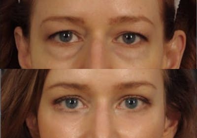 Brow Lift Before & After Gallery - Patient 233691 - Image 2