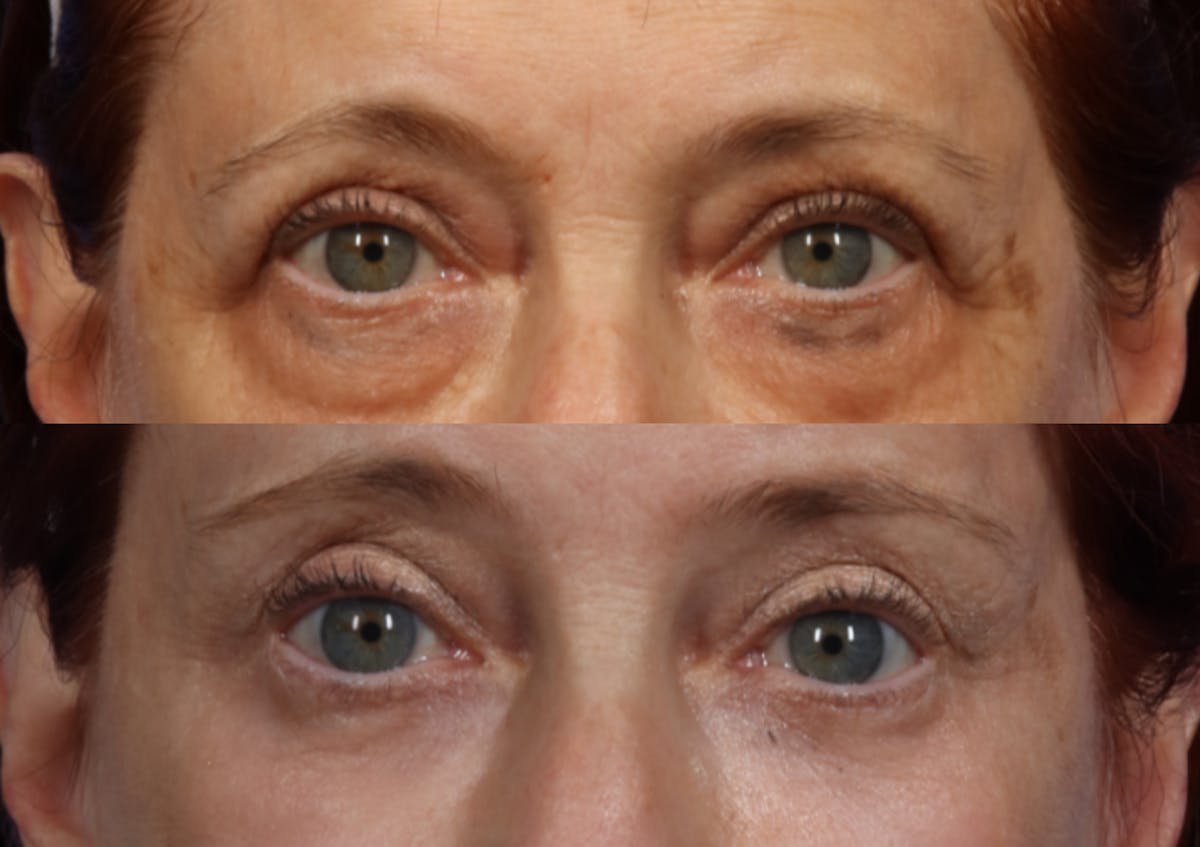 Brow Lift Before & After Gallery - Patient 154825 - Image 2