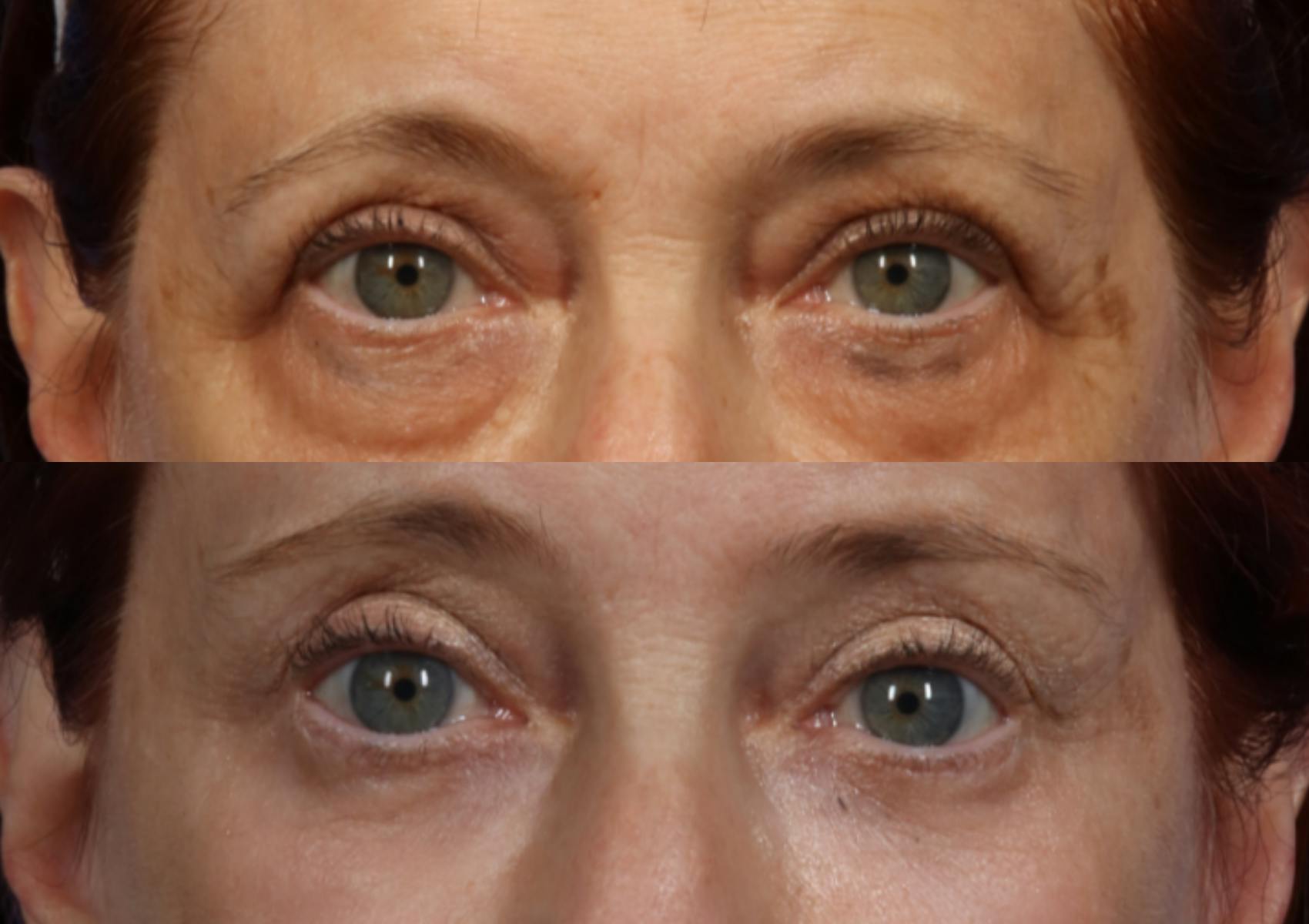 Brow Lift Before & After Gallery - Patient 154825 - Image 2