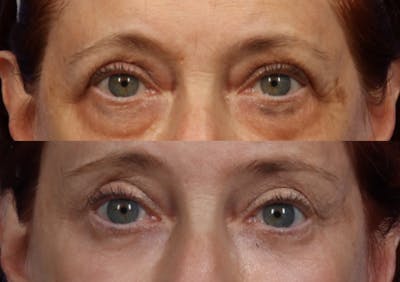Brow Lift Before & After Gallery - Patient 154825 - Image 2