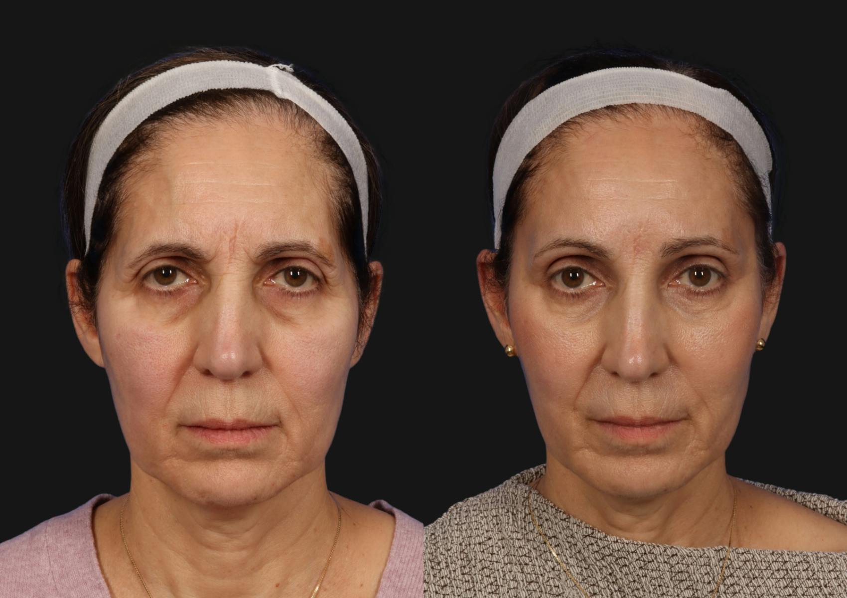 Brow Lift Before & After Gallery - Patient 293205 - Image 1