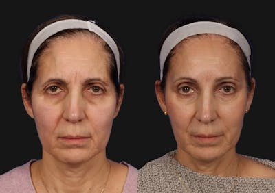 Brow Lift Before & After Gallery - Patient 293205 - Image 1