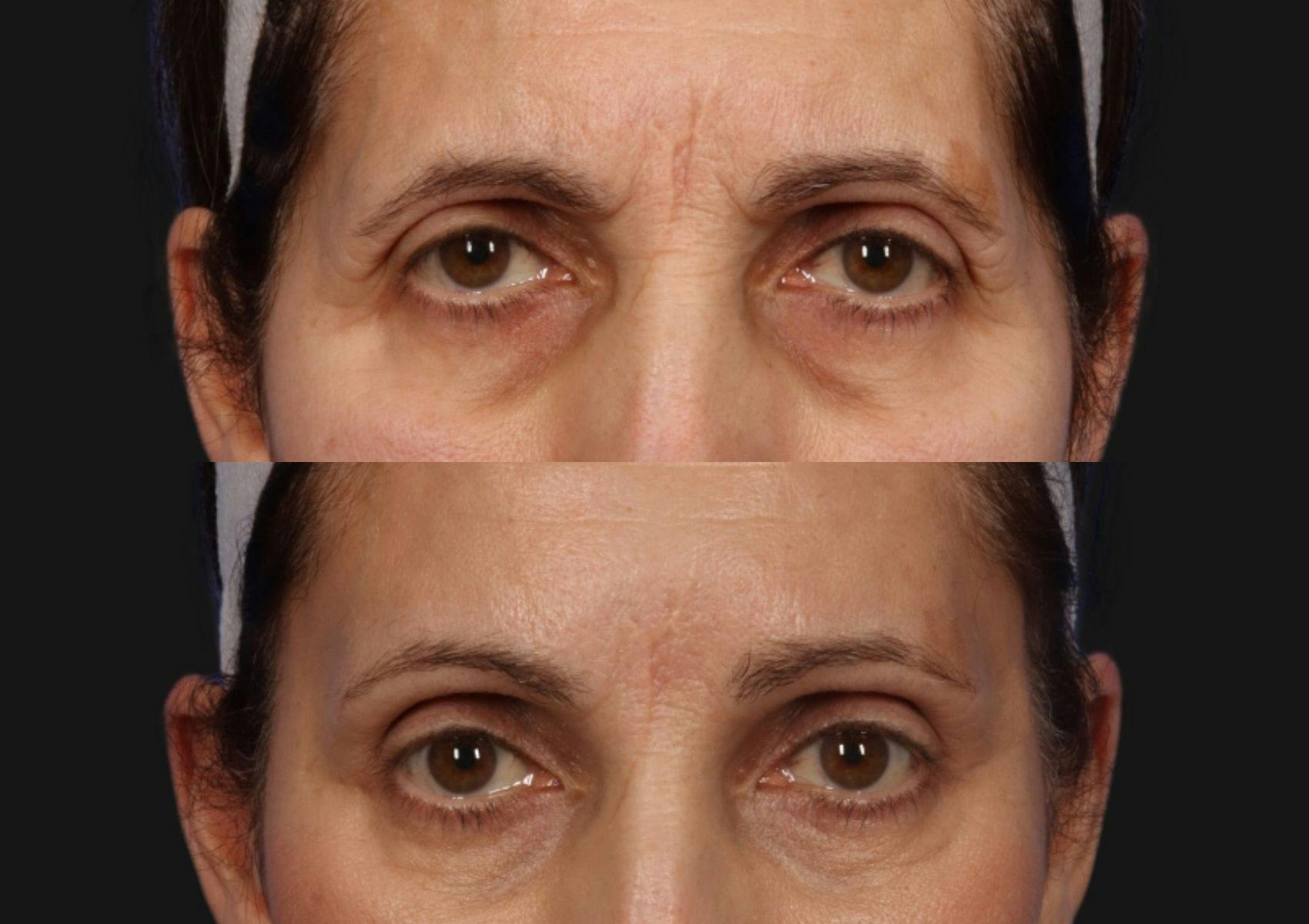 Brow Lift Before & After Gallery - Patient 293205 - Image 2