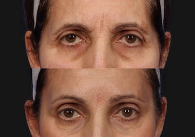 Brow Lift Before & After Gallery - Patient 293205 - Image 2