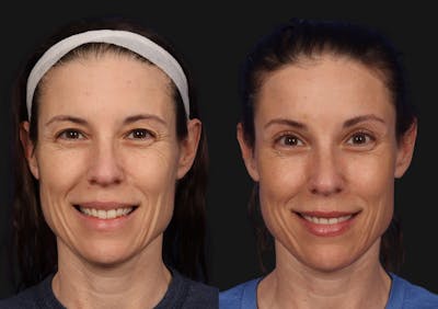 Brow Lift Before & After Gallery - Patient 174988 - Image 1