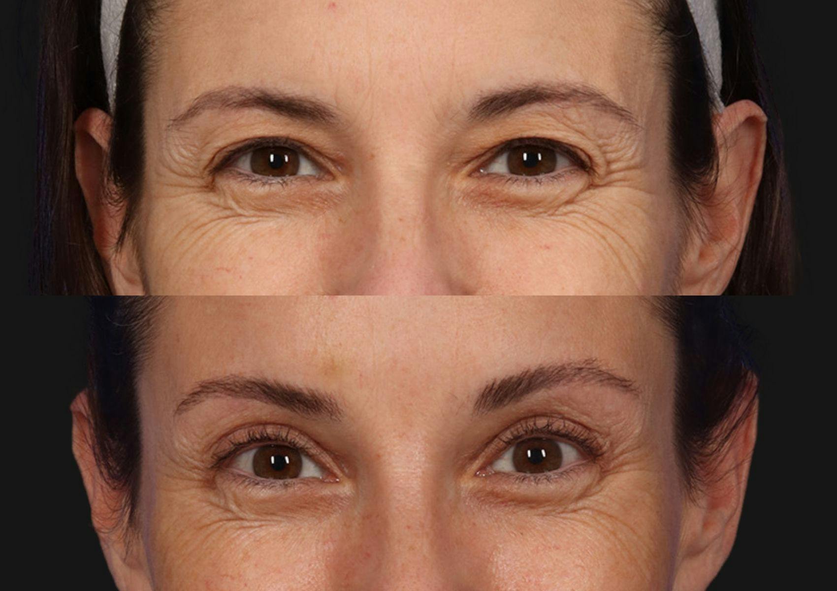 Brow Lift Before & After Gallery - Patient 174988 - Image 2