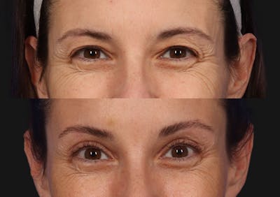 Brow Lift Before & After Gallery - Patient 174988 - Image 2