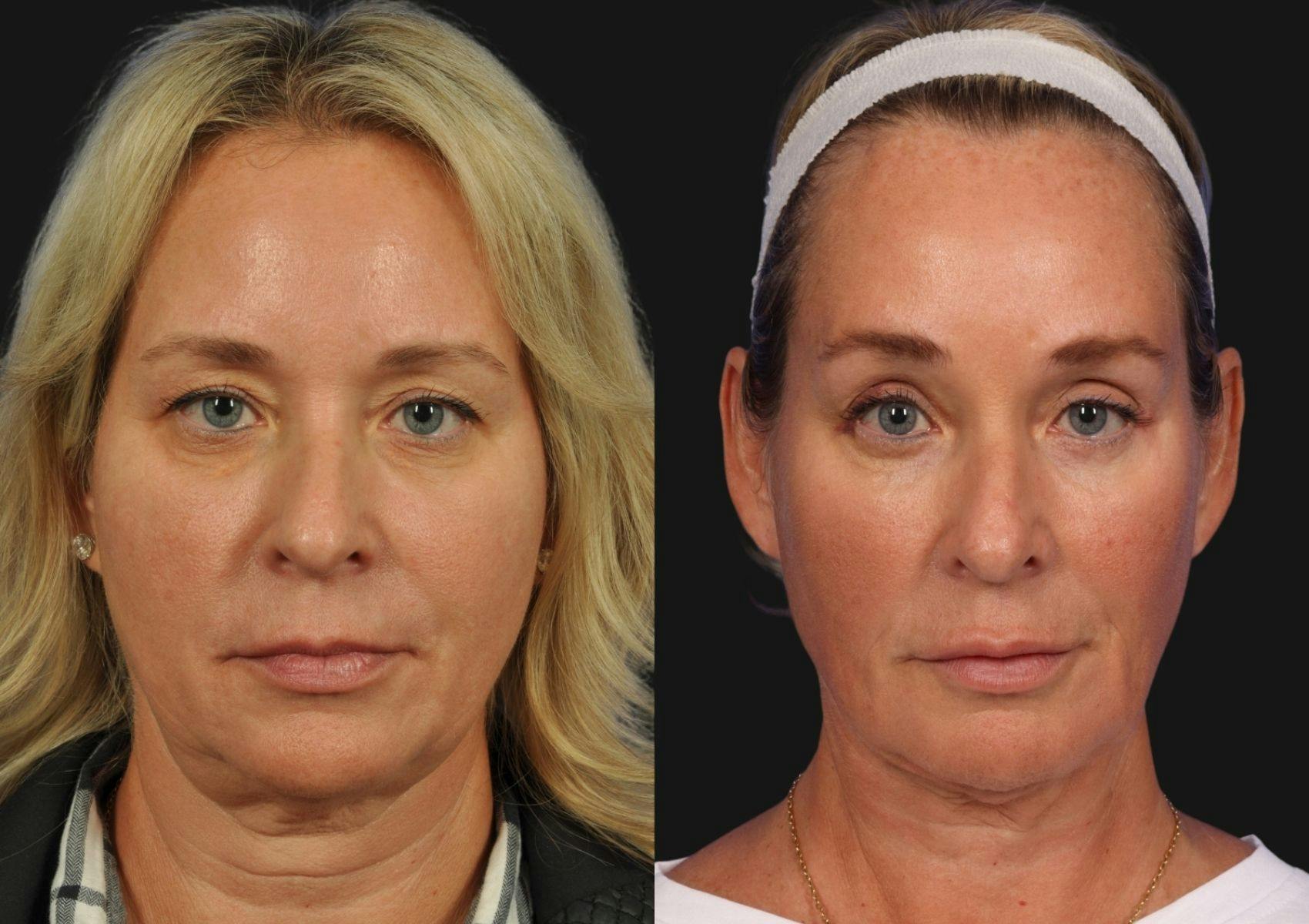 Brow Lift Before & After Gallery - Patient 792533 - Image 1