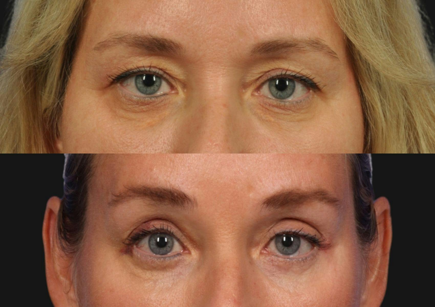 Brow Lift Before & After Gallery - Patient 792533 - Image 2
