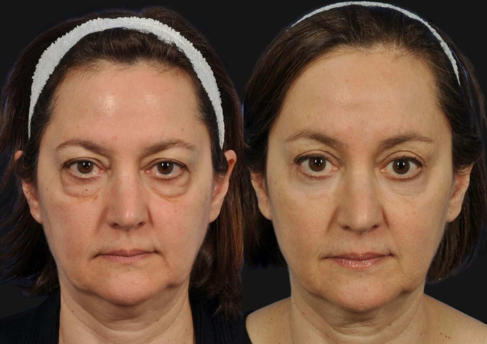 Brow Lift Before & After Gallery - Patient 136938 - Image 1