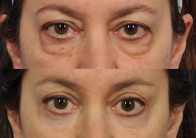 Brow Lift Before & After Gallery - Patient 136938 - Image 2