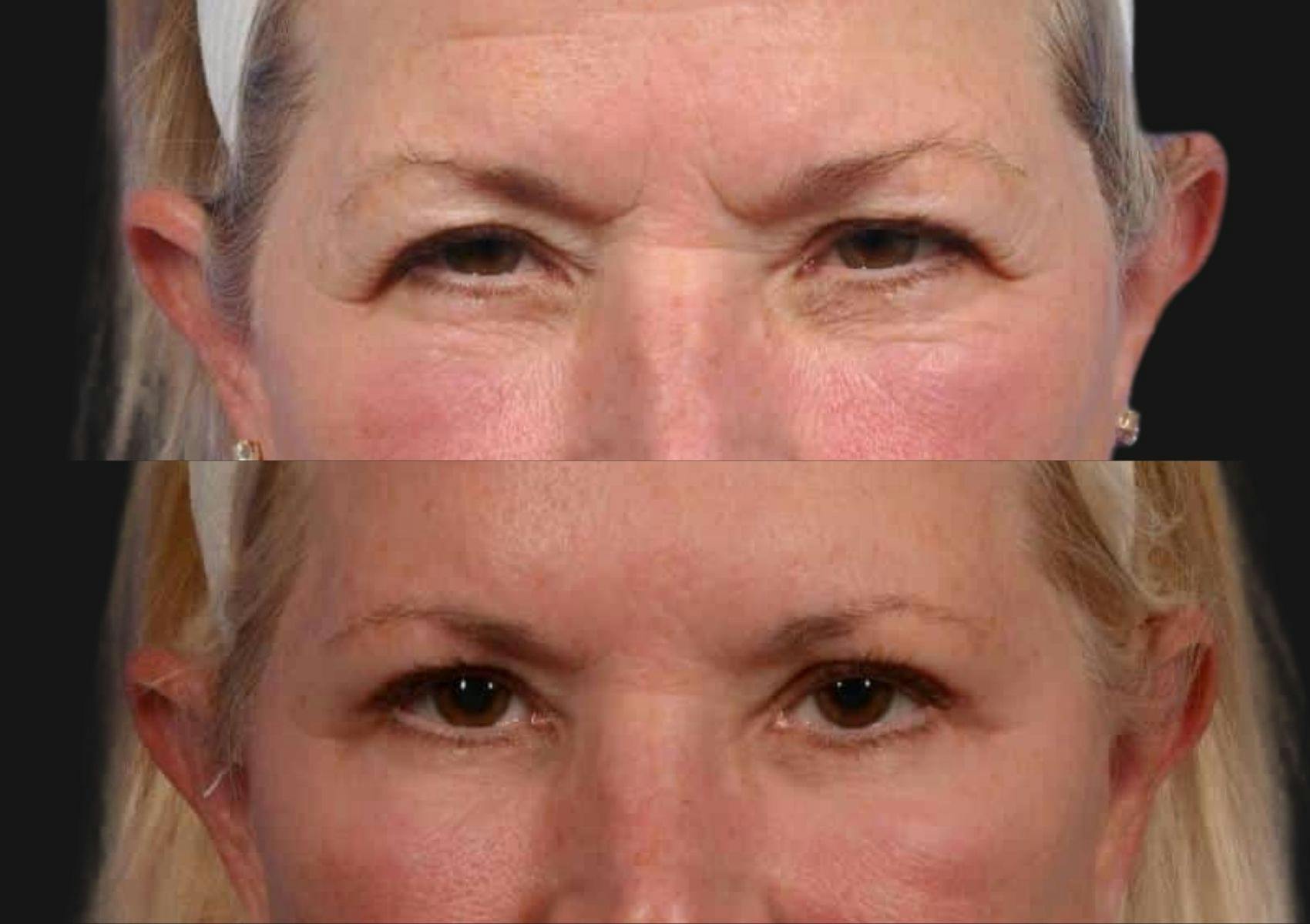 Brow Lift Before & After Gallery - Patient 733570 - Image 2