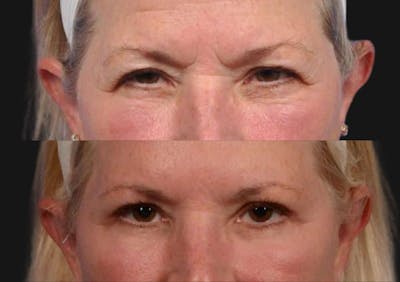 Brow Lift Before & After Gallery - Patient 733570 - Image 2