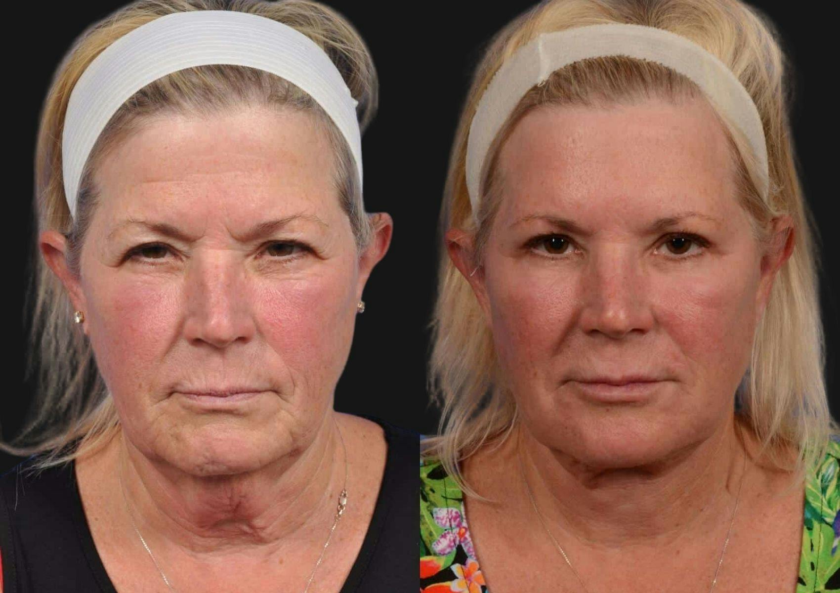 Brow Lift Before & After Gallery - Patient 733570 - Image 1