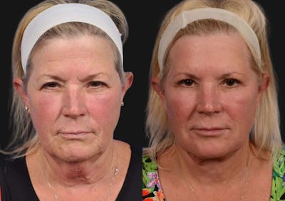 Brow Lift Before & After Gallery - Patient 733570 - Image 1