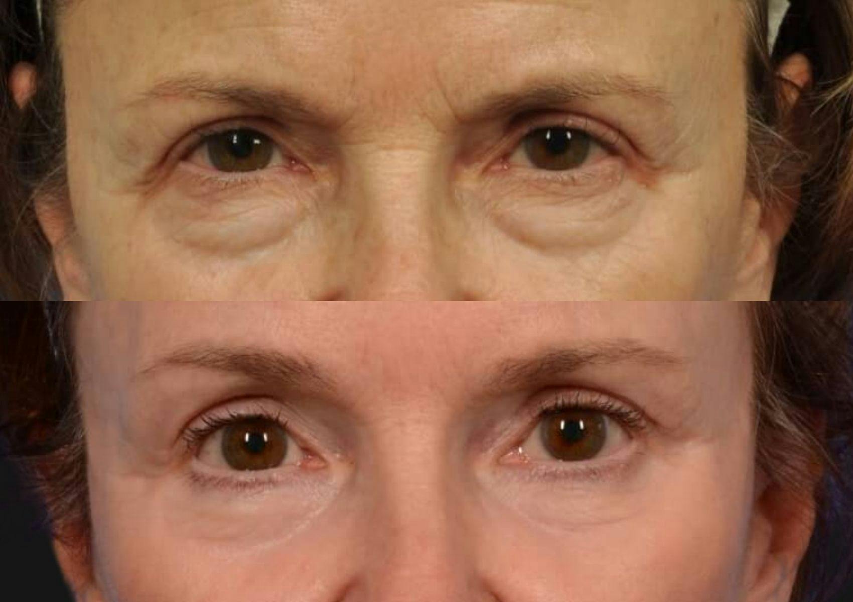 Brow Lift Before & After Gallery - Patient 367327 - Image 2