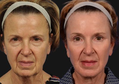 Brow Lift Before & After Gallery - Patient 367327 - Image 1