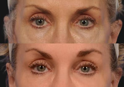 Brow Lift Before & After Gallery - Patient 109831 - Image 2