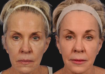 Brow Lift Before & After Gallery - Patient 109831 - Image 1