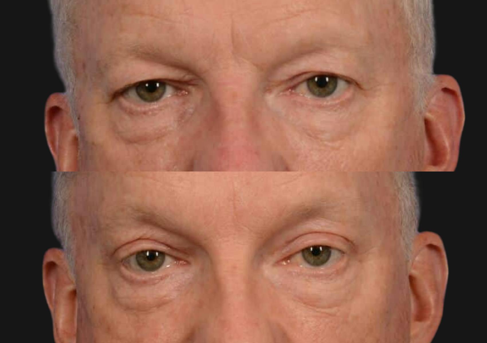 Brow Lift Before & After Gallery - Patient 136742 - Image 2